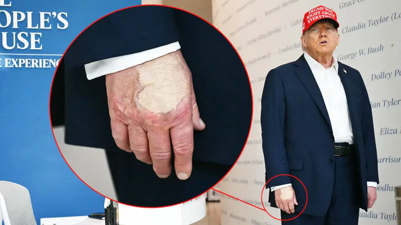 Trump’s hand makeup sparks new health debate
