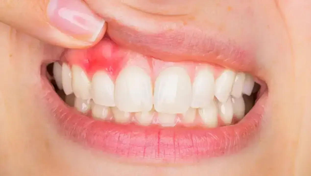 Why does gum swell and how can it be eliminated?