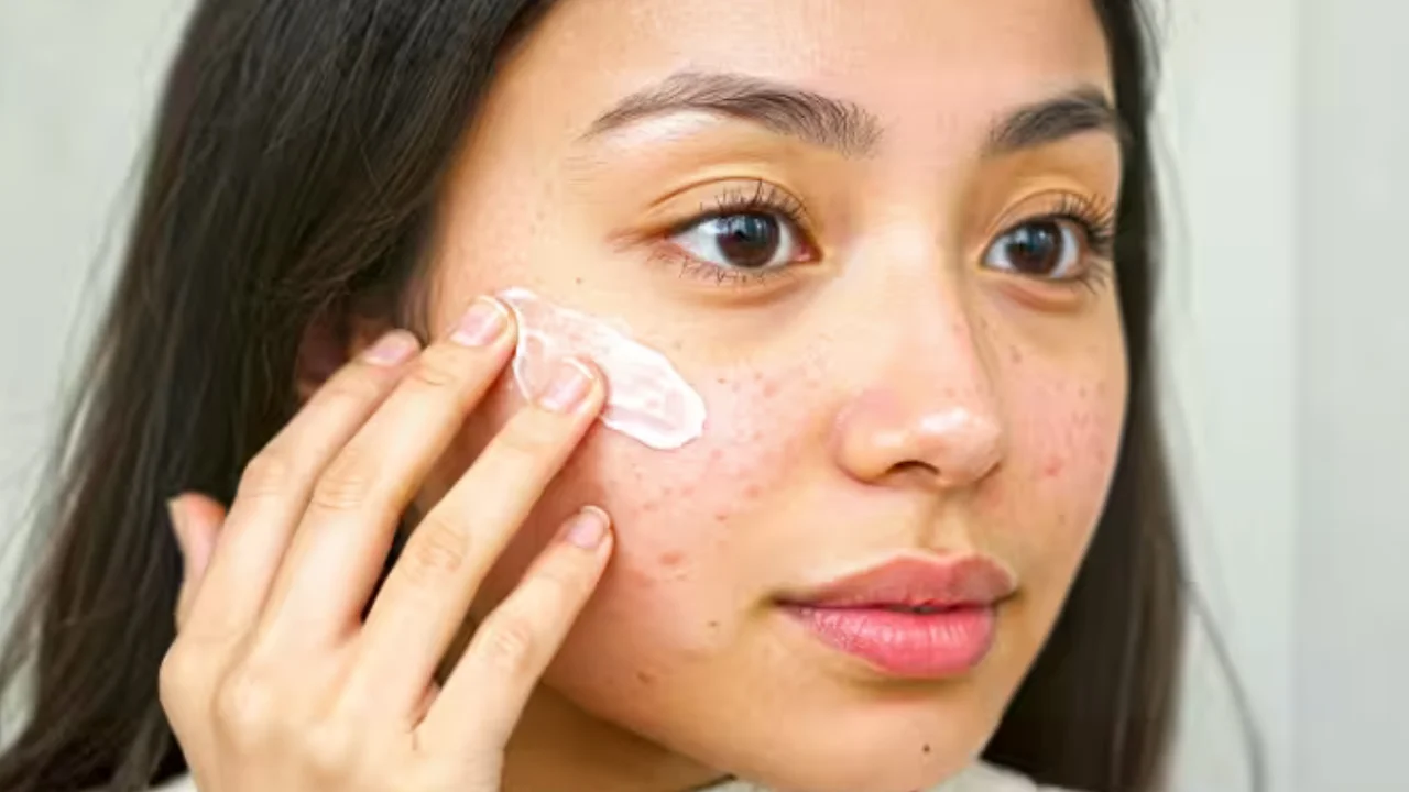 Ҳуснбузарлар нега чиқади?