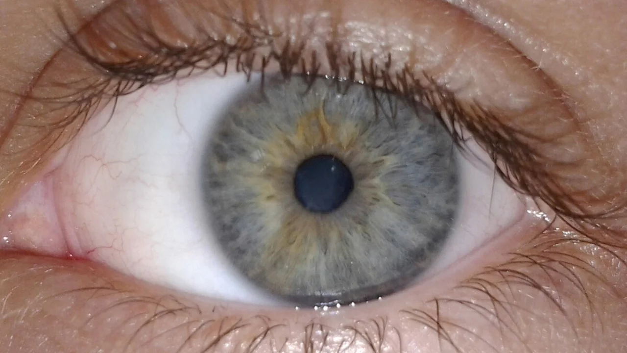 Омскда шифокорлар аёлнинг кўзидан тирик қурт олиб чиқишди