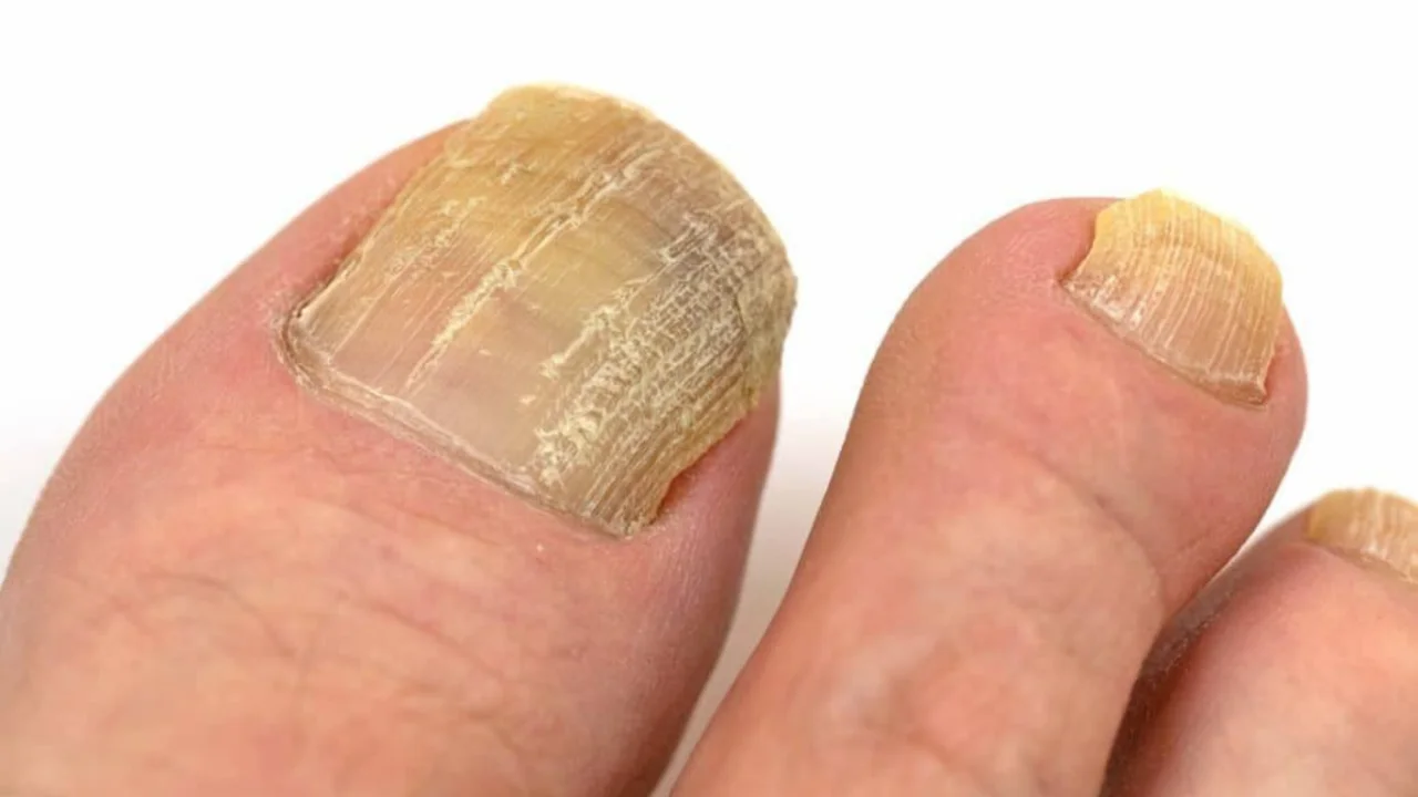 Yosh o‘tgan sayin tirnoq nega qattiqlashadi? Sabab aniq!