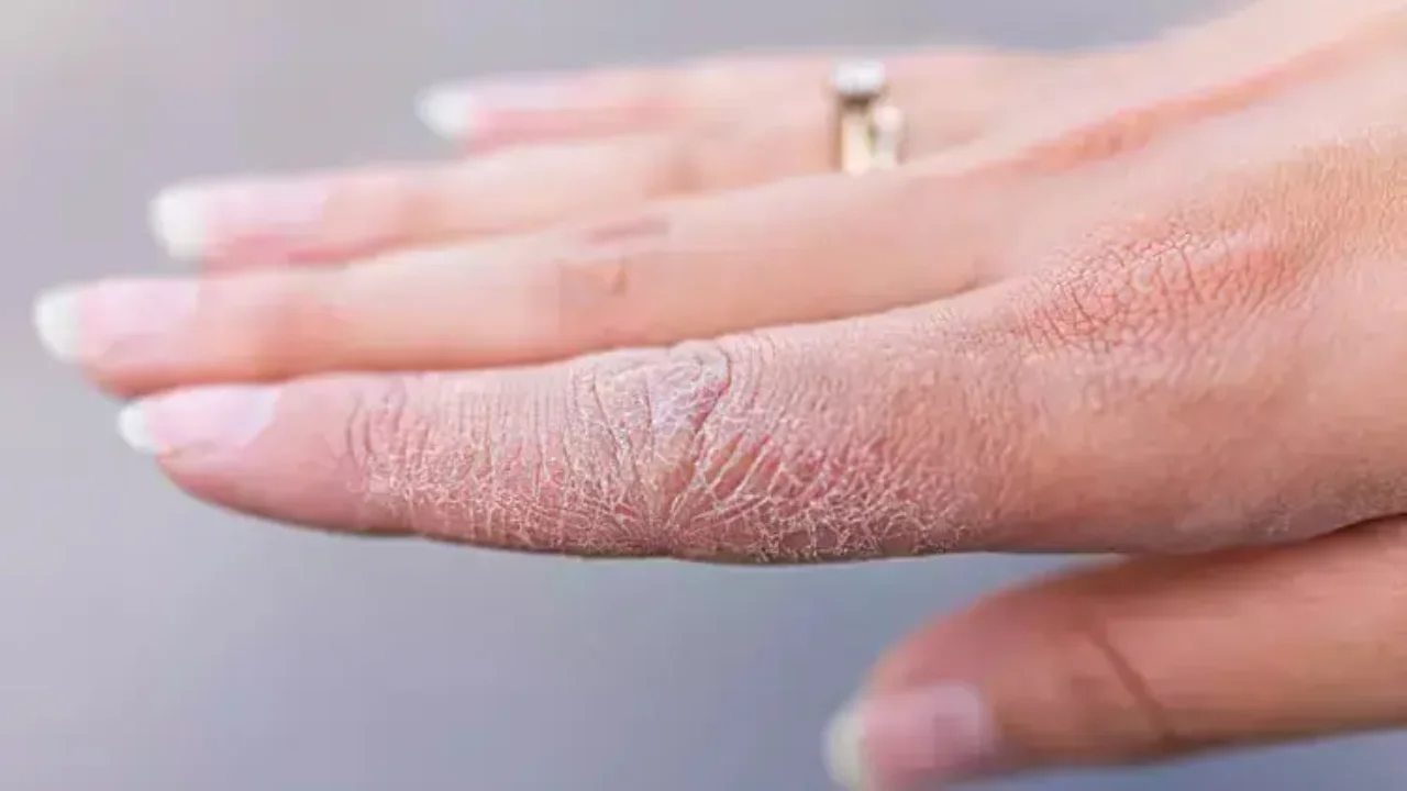 Секреты борьбы с сухой кожей: причина, опасность и лечение