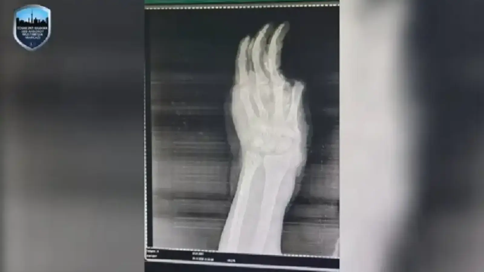 Тошкентда пиротехника портлаши боланинг қўлини олиб кетди