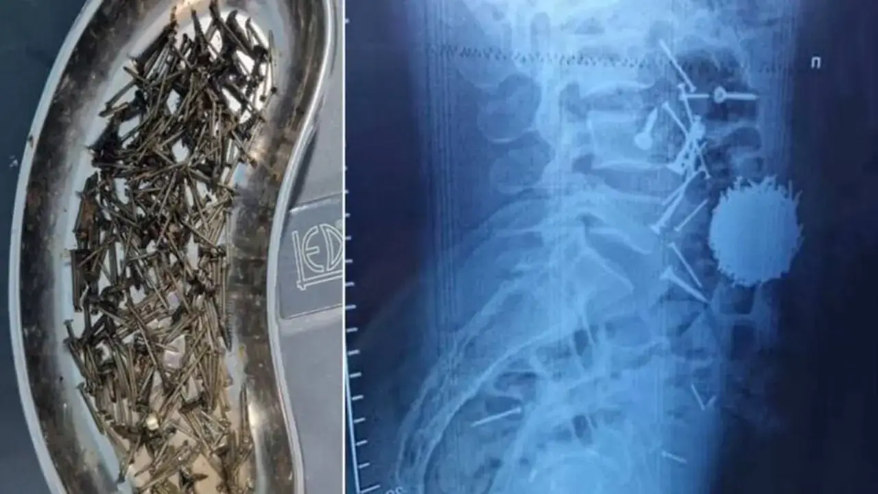 200 grams of nails were found in the stomach of a 29-year-old man in Samarkand