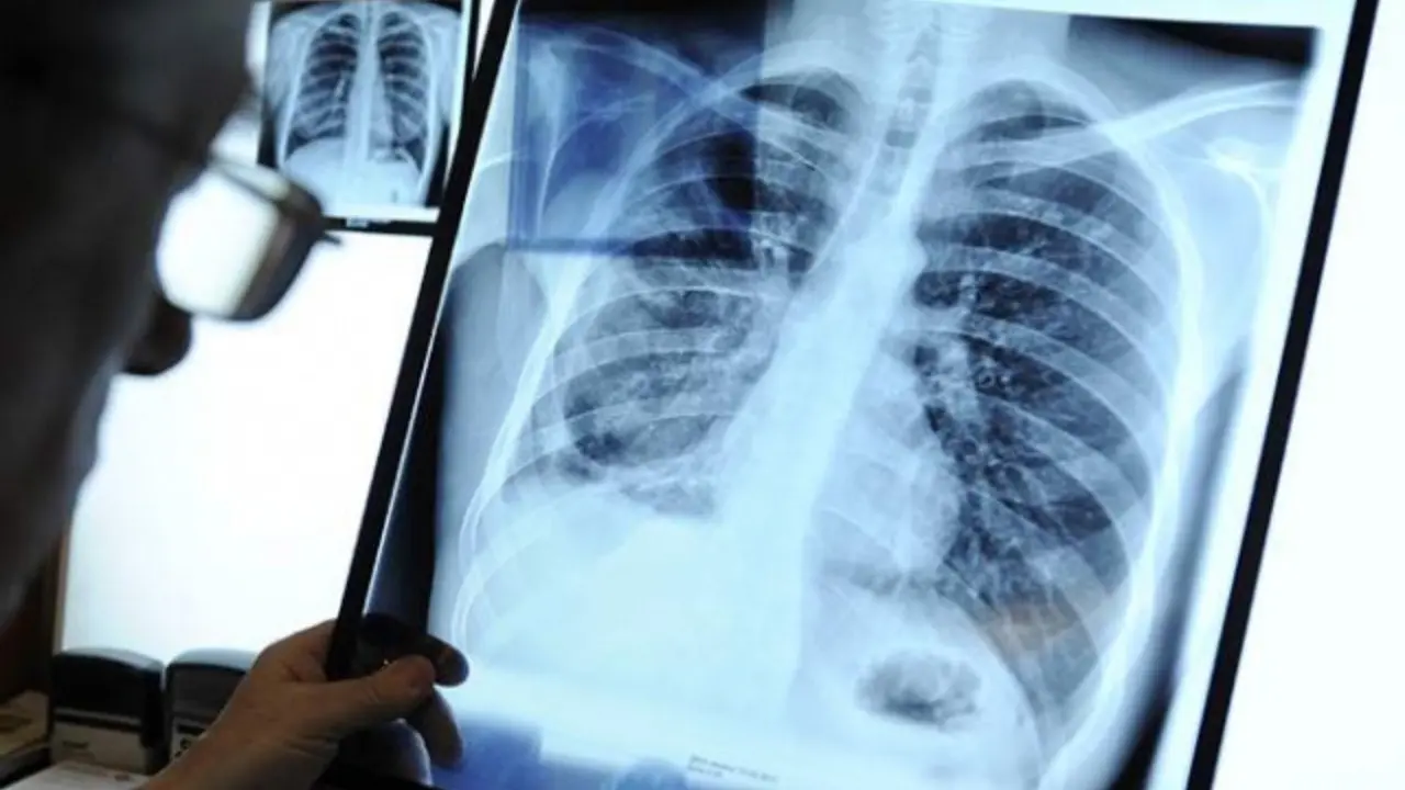 Шифокорлар ярим йил деган, у эса 40 йил яшади саратонинг якуний босқичи билан