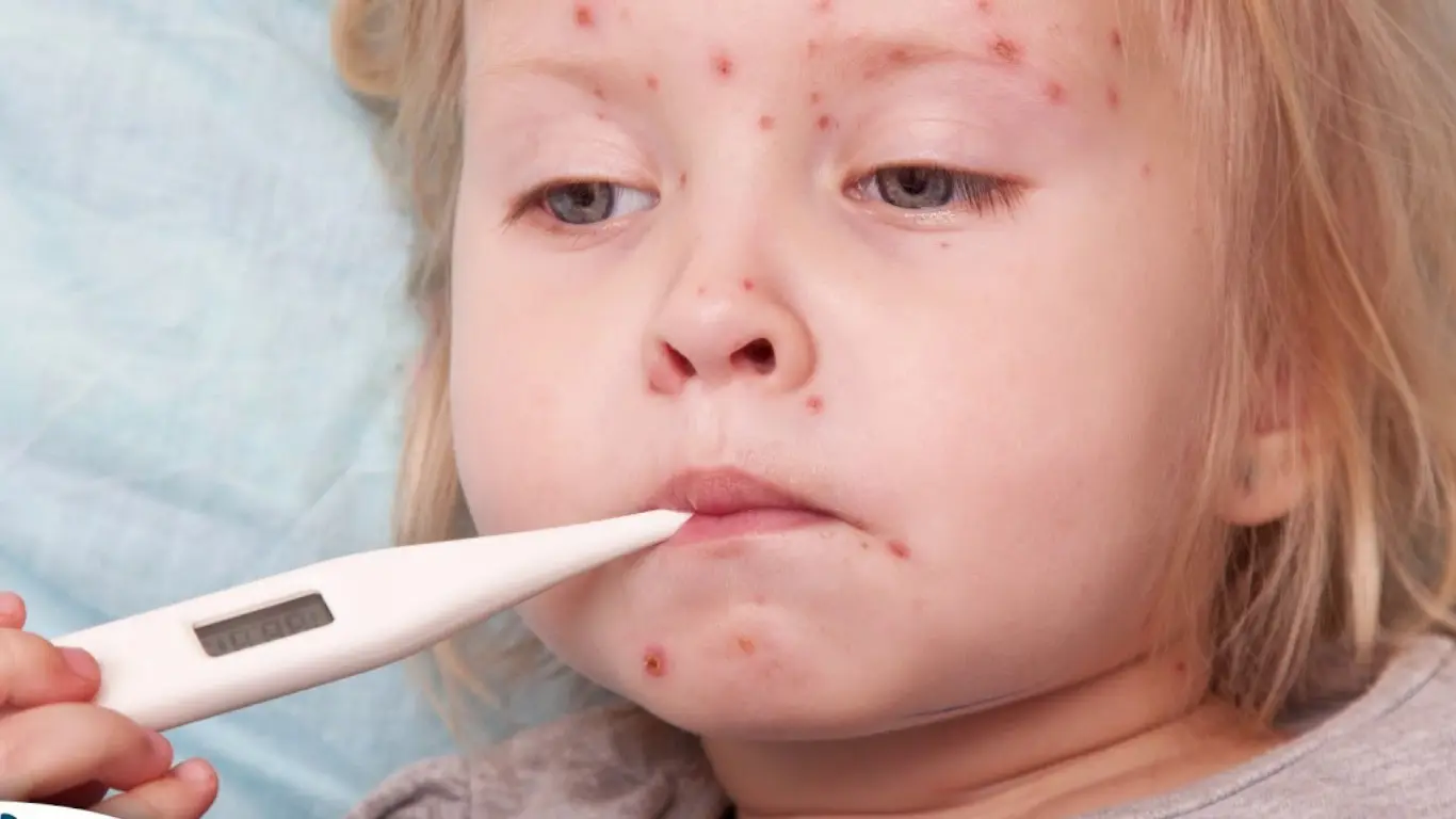 Londondagi Enfildda 60 dan ortiq bolada qizamiq aniqlandi