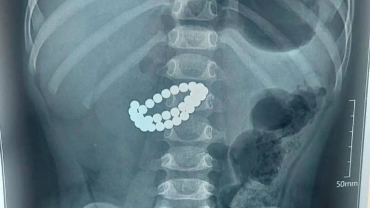 Qozog‘istonda 31 ta magnit yutgan bola operatsiya bilan qutqarildi