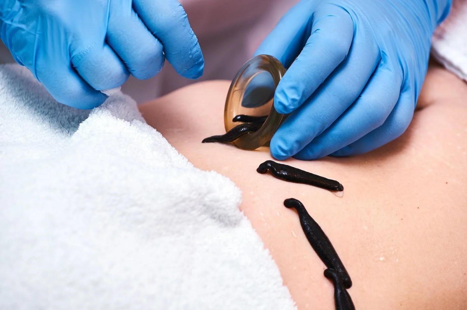 Tabiatning jonli dorisi: Girudoterapiya haqida siz bilmagan muhim faktlar