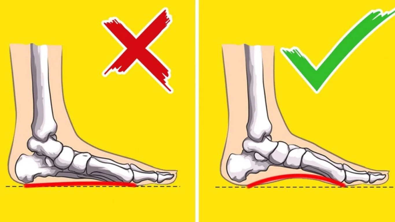 Bolalarda yassioyoqlik sabablari va uning xavflari