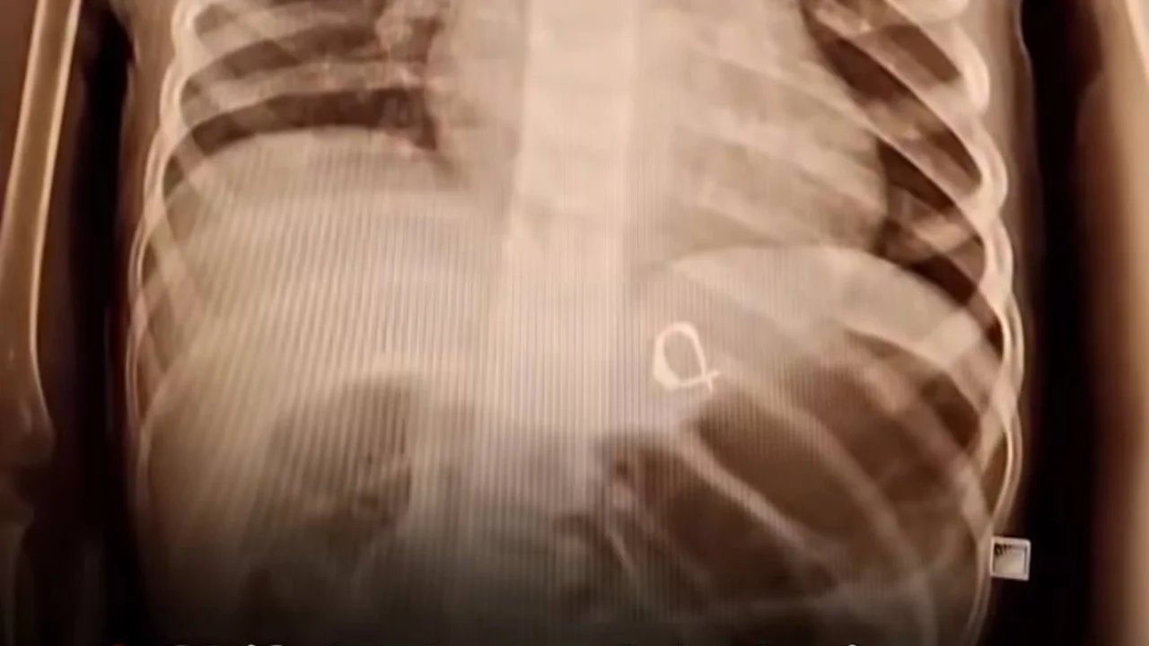 Des médecins découvrent une boucle d'oreille dans l'estomac d'un enfant de trois ans