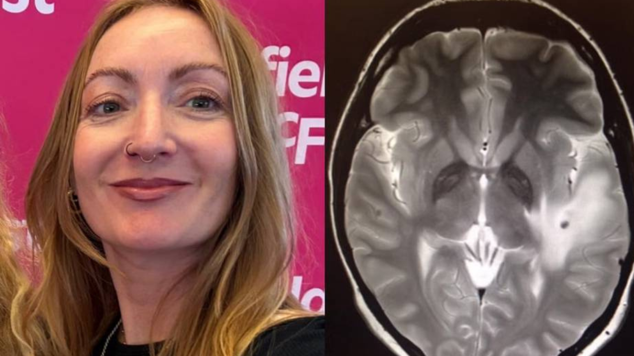 38 parásitos hallados en el cerebro de una mujer tras un viaje a la India