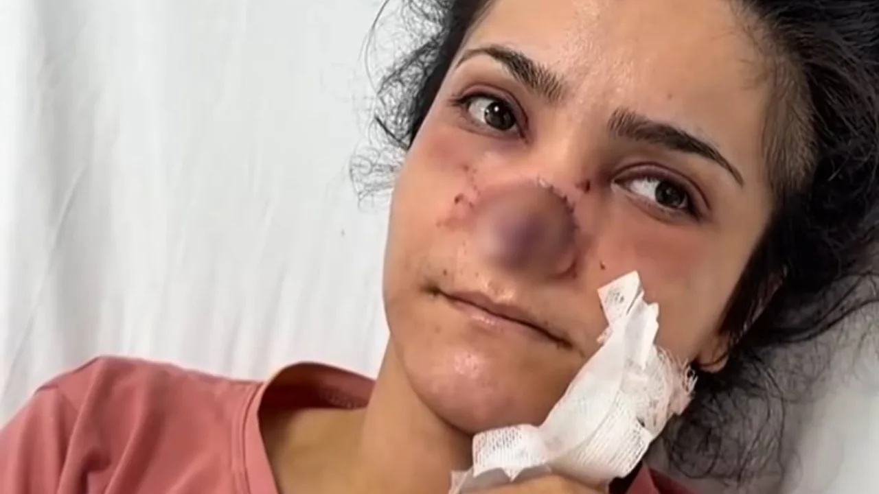 Man in Turkey bites off his wife's nose