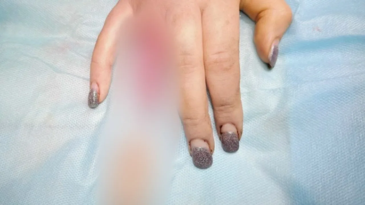 Una mujer casi pierde un dedo debido a su anillo de bodas