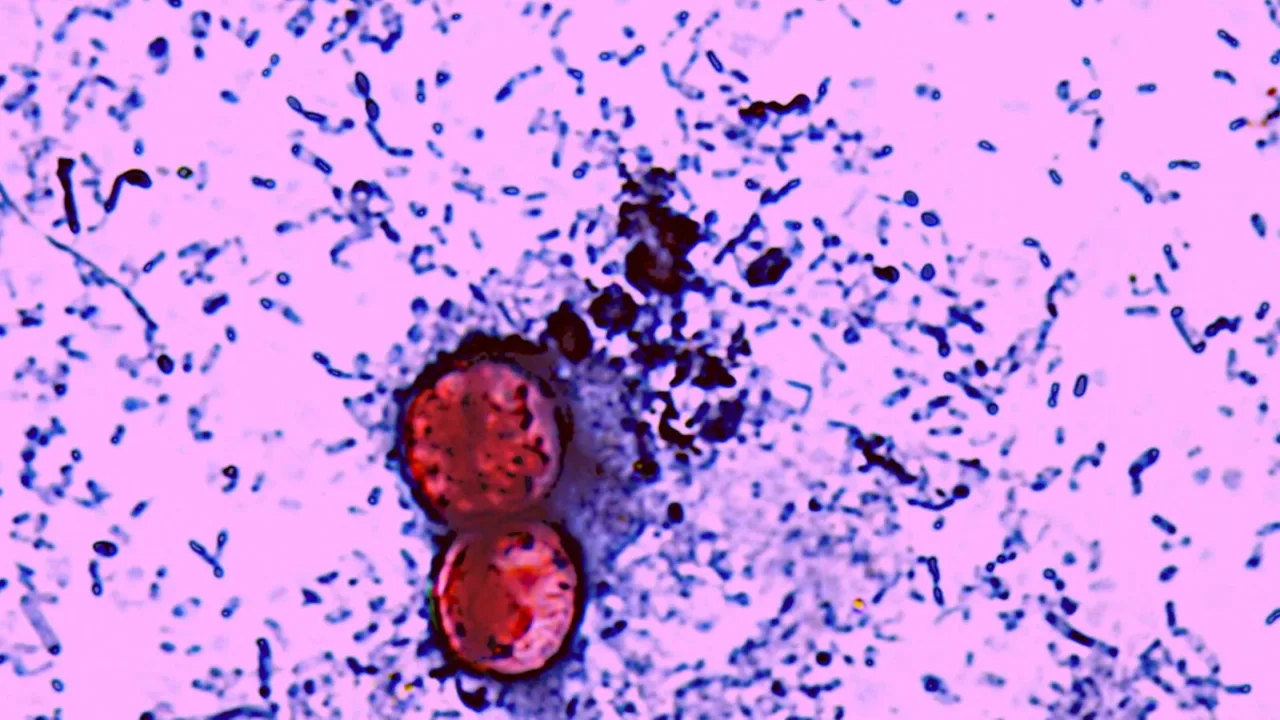 Dangerous Parasite Outbreak in the US Causes First Deaths