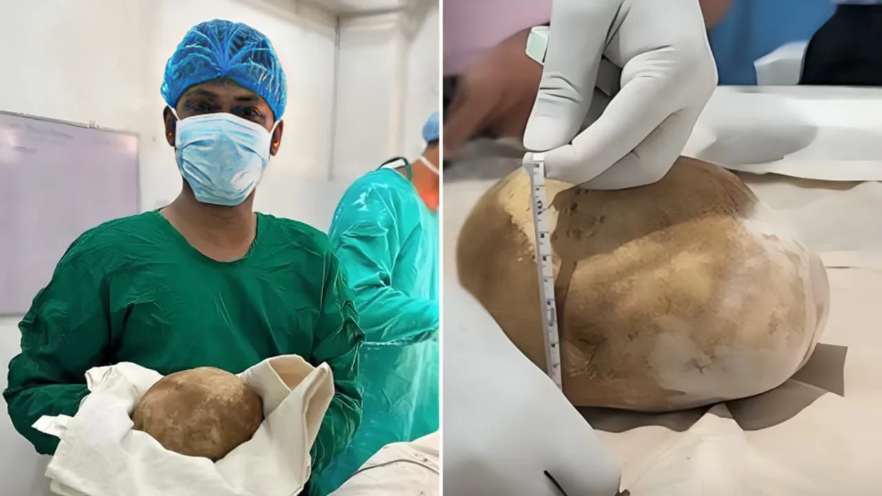 3.1-kilogram bladder stone removed from 55-year-old man in Sri Lanka