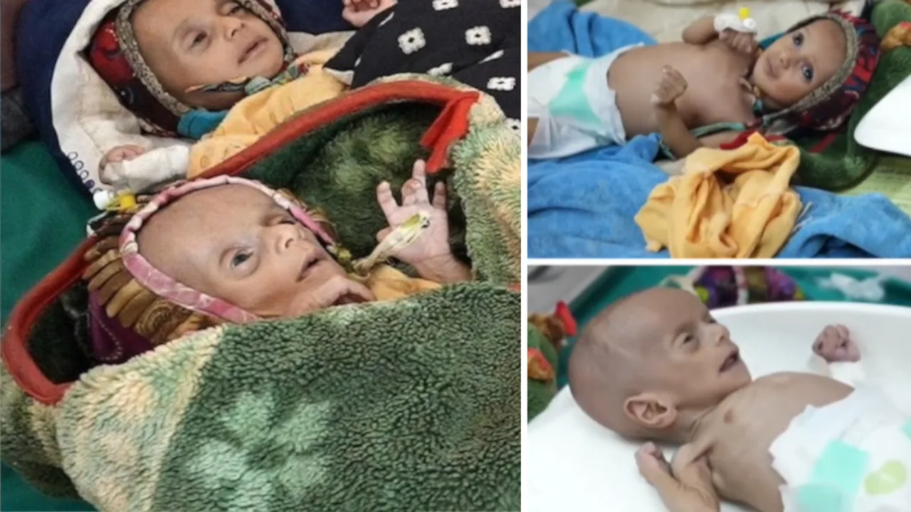 Twins fighting hunger in Yemen