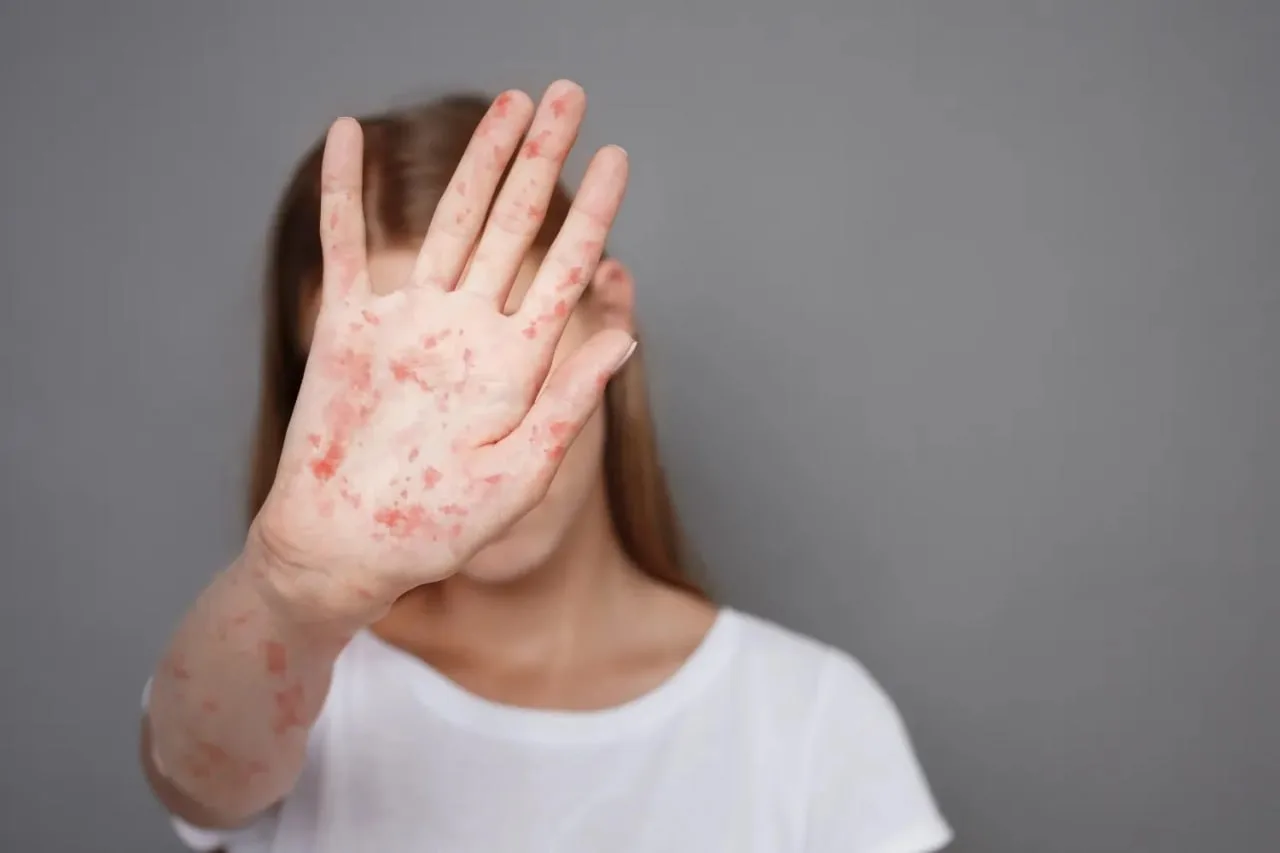 35-year anti-record in the US: State of emergency declared due to measles outbreak