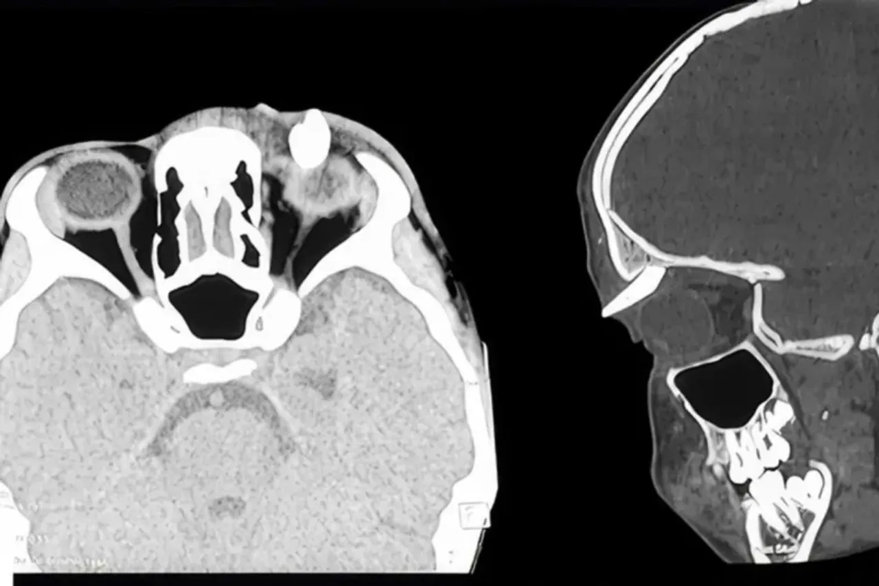 The computed tomography scan of the skull shows the foreign body and damage in the eye socket.