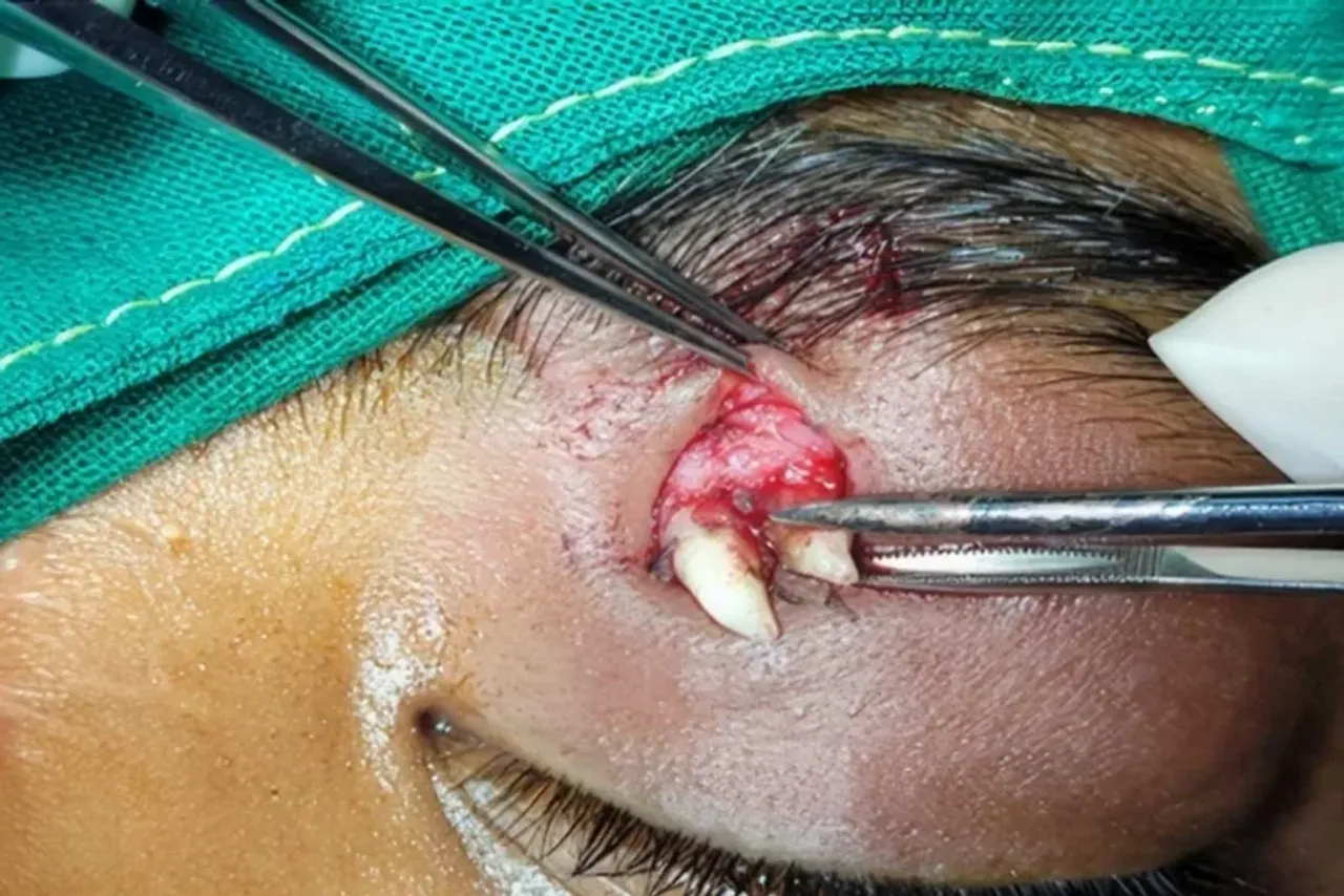 A tooth is being removed from the eyelid using surgical instruments.