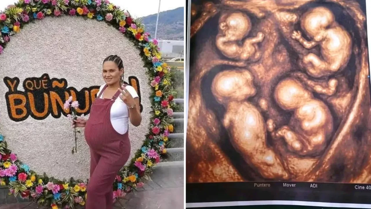 38-year-old woman is expecting identical quadruplet boys at once