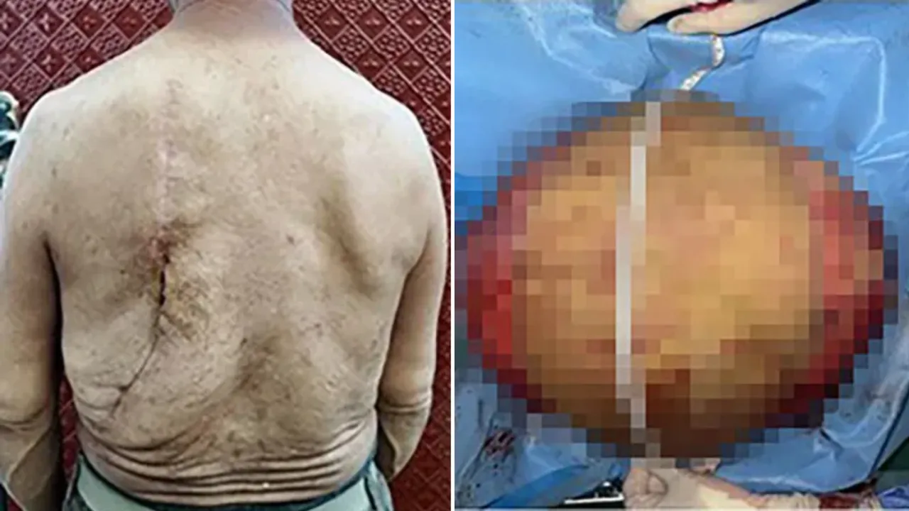 Odamning orqasidagi chandiq va operatsiya yo'li bilan olib tashlangan katta o'simta.